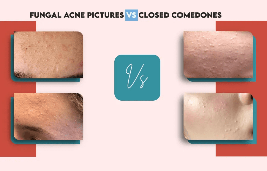 How to Get Poreless Skin and Make Everyone Lowkey Jealous (Weekly + Daily Skin Care Routine). Fungal Acne Vs Closed Comedones: What’s The Difference?