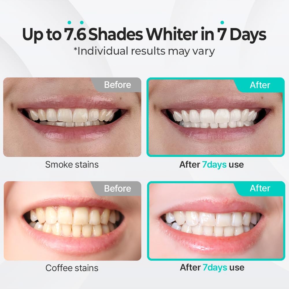 AMAZON | LIVEORALS | Teeth Whitening Kit - Gel + Mouthpiece Set – hydrogen peroxide, Dentist Formulated for Sensitive Teeth, 28 Treatments